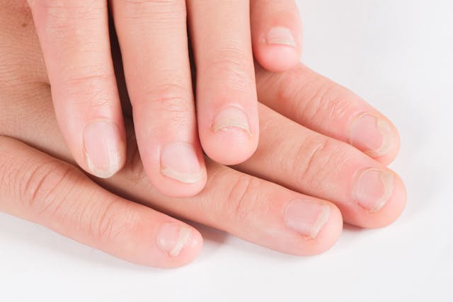 Onychomycosis or fungal nail infection on damaged nails after gel polish, onychosis. | Image Credit: © zhikun sun - stock.adobe.com