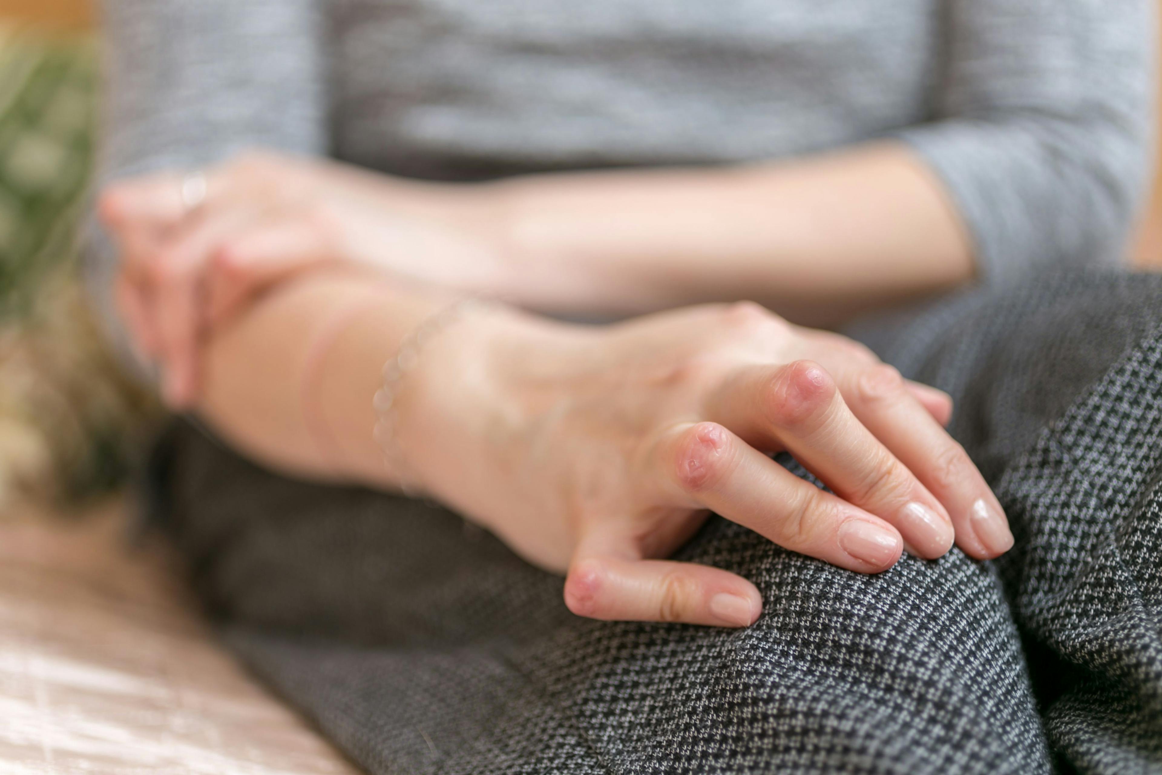 Young woman having rheumatoid arthritis takes a rest sittinng on the couch. Hands and legs are deformed. She feels pain. Selected focus. | Image Credit: © Valentina - stock.adobe.com
