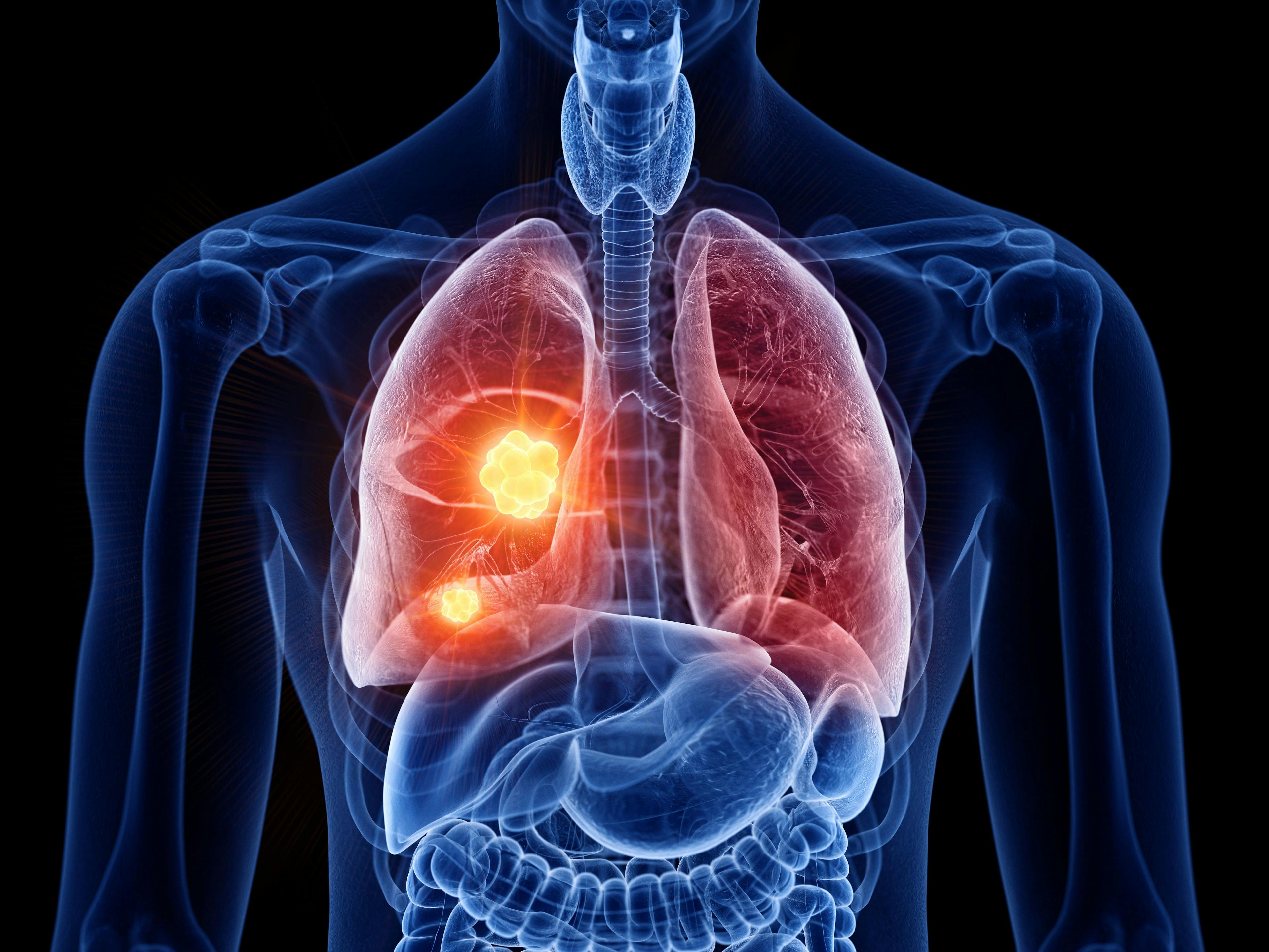 3d rendered medically accurate illustration of lung cancer | Image Credit: © SciePro - stock.adobe.com