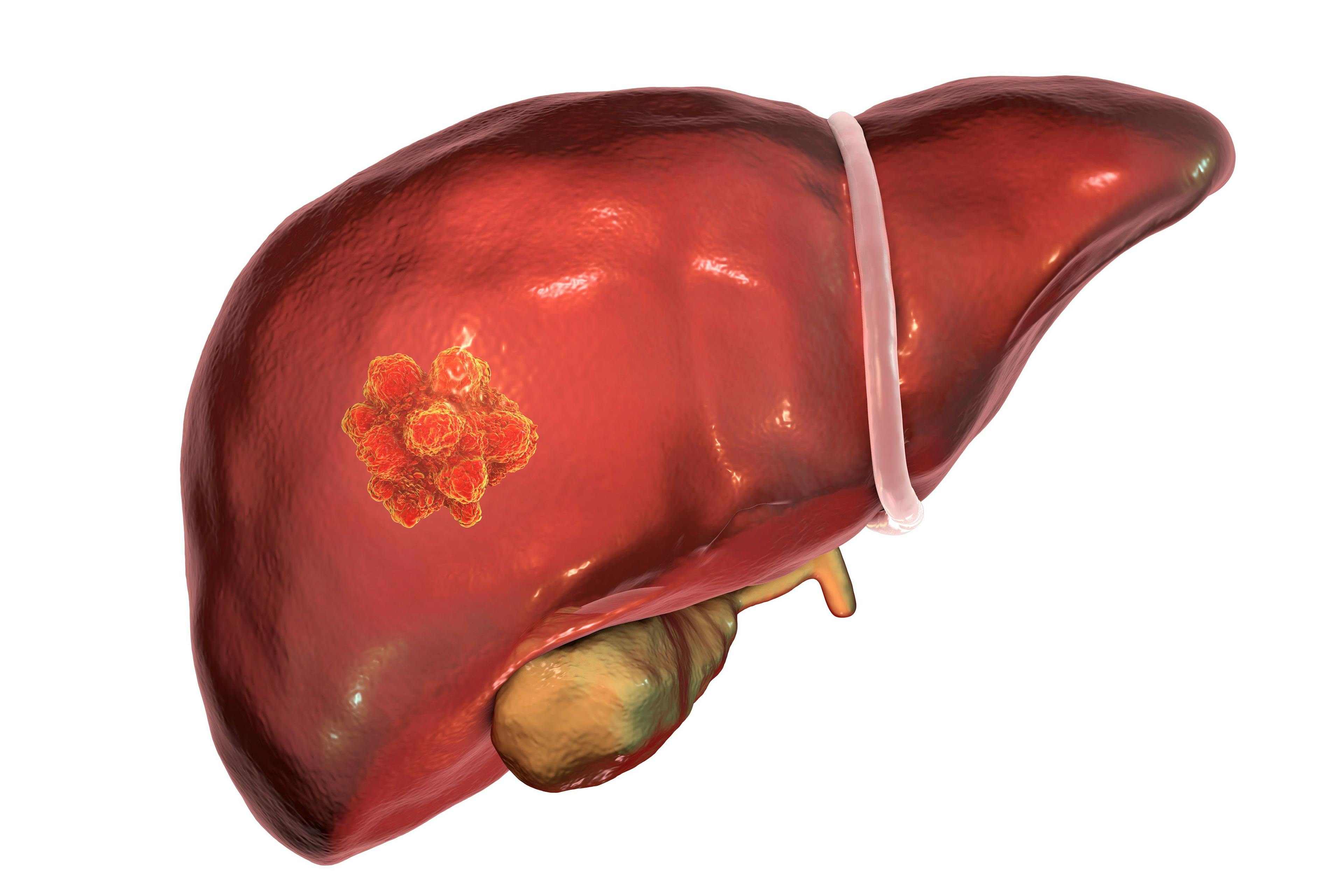  Liver cancer. 3D illustration showing presence of tumor inside liver | Image Credit: © Dr_Microbe - stock.adobe.co