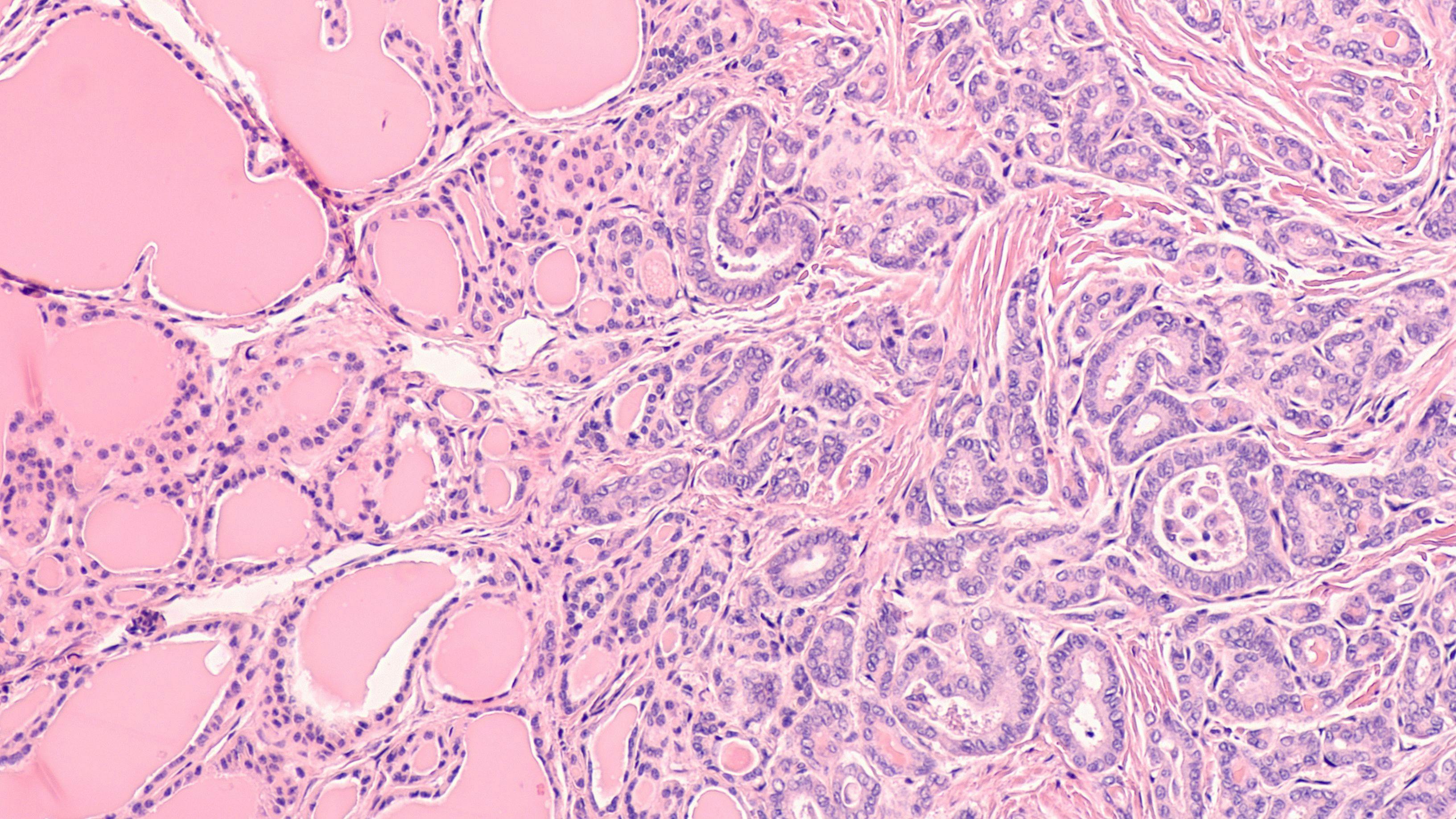 Thyroid gland cancer awareness: Microscopic image of papillary thyroid carcinoma, follicular variant (left), with invasion into benign follicles or normal thyroid tissue (right). | Image Credit: © David A Litman - stock.adobe.com