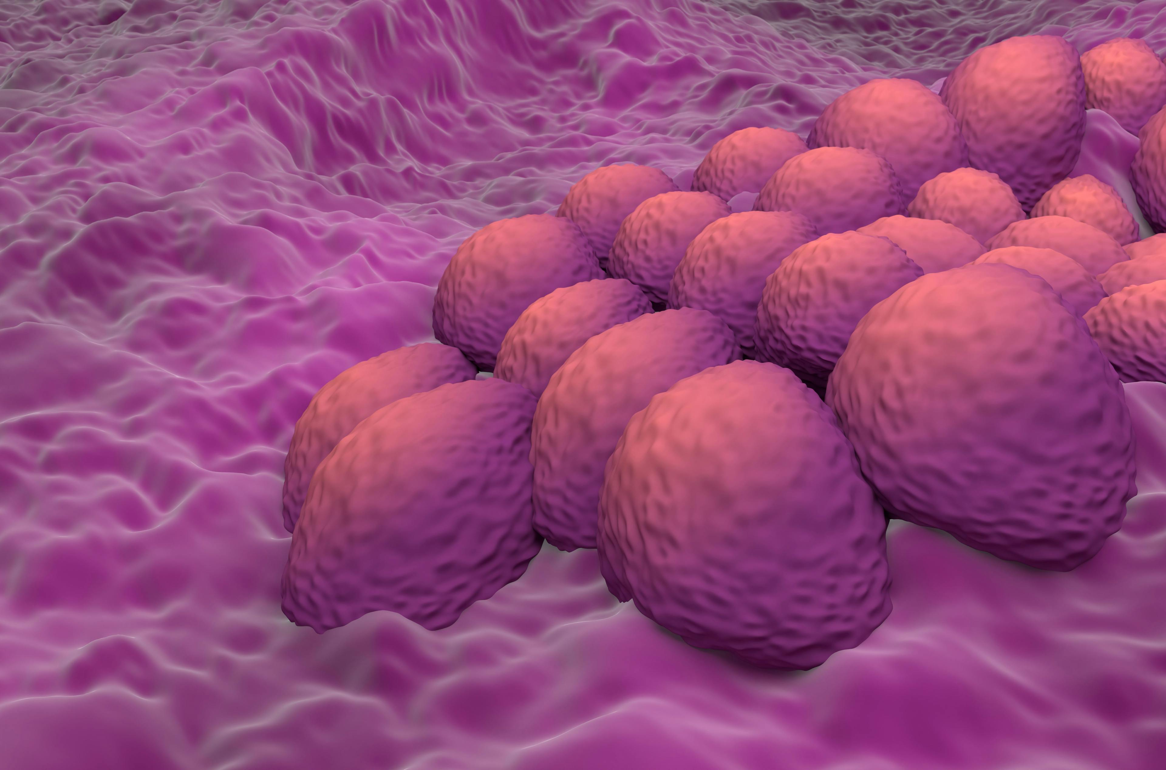 Endometrial cancer cells (adenocarcinoma) in the uterus or cervix (womb neck) - closeup view 3d illustration | Image Credit: © LASZLO