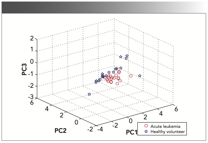 FIGURE 5: Three-dimensional (3D) mapping of PCA from the acute leukemia group, and healthy volunteer group. Shown are the discrimination results of PCA from healthy volunteer group (o) and acute leukemia group (☆). They can be separated completely.