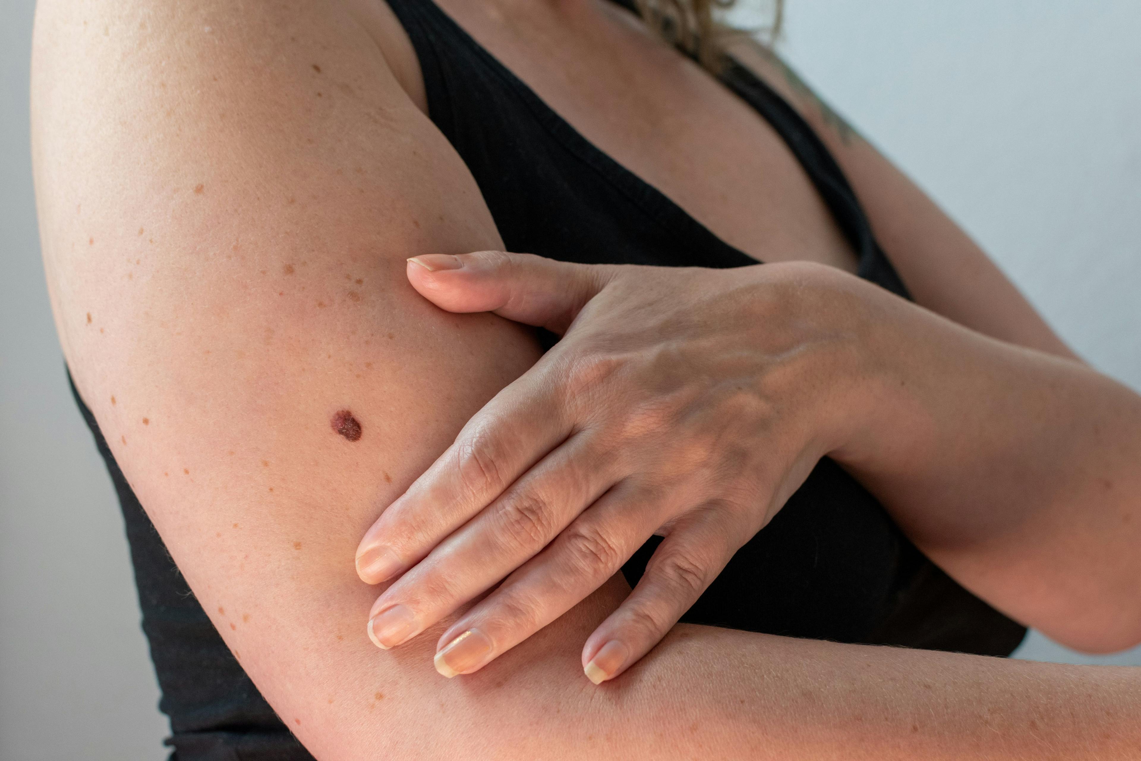 a womans arm with an abnormal mole that was diagnosed as being malignant melanoma skin cancer | Image Credit:  MW Photography - stock.adobe.com