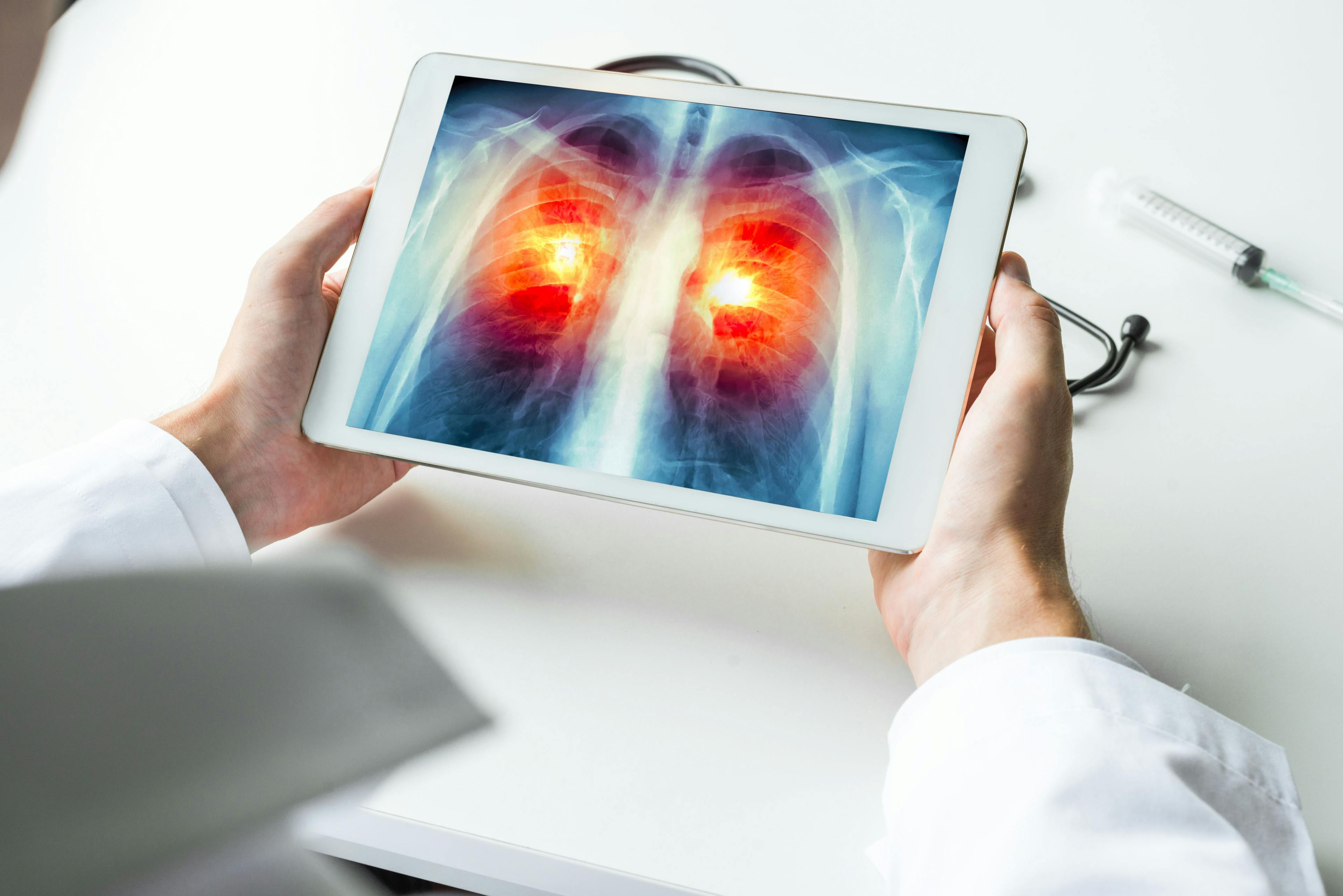 Doctor watching a xray of lung cancer on digital tablet. Radiology concept | Image Credit: © steph photographies - stock.adobe.com