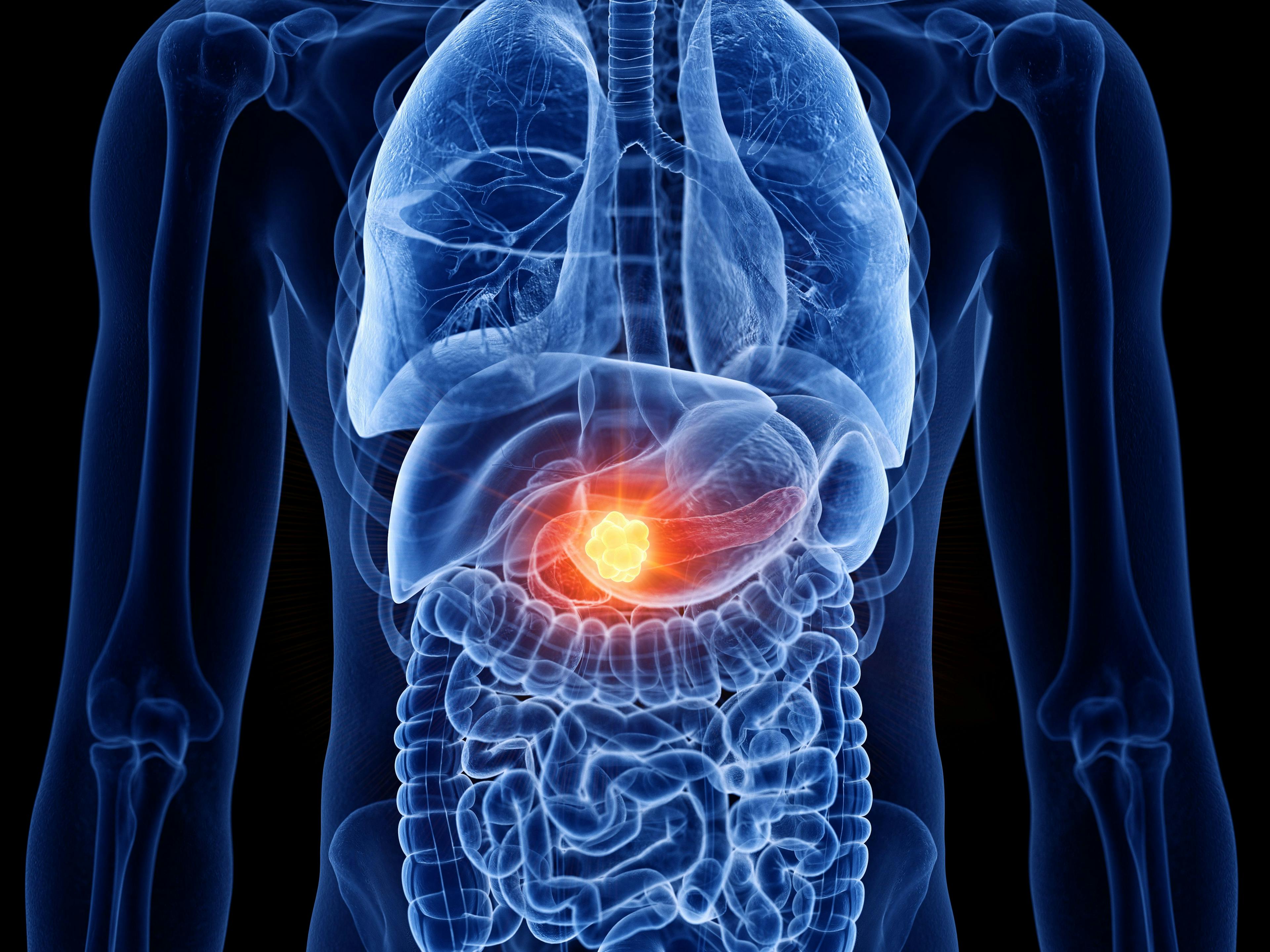 3d rendered medically accurate illustration of pancreas cancer | Image Credit: © Sebastian Kaulitzki - stock.adobe.com
