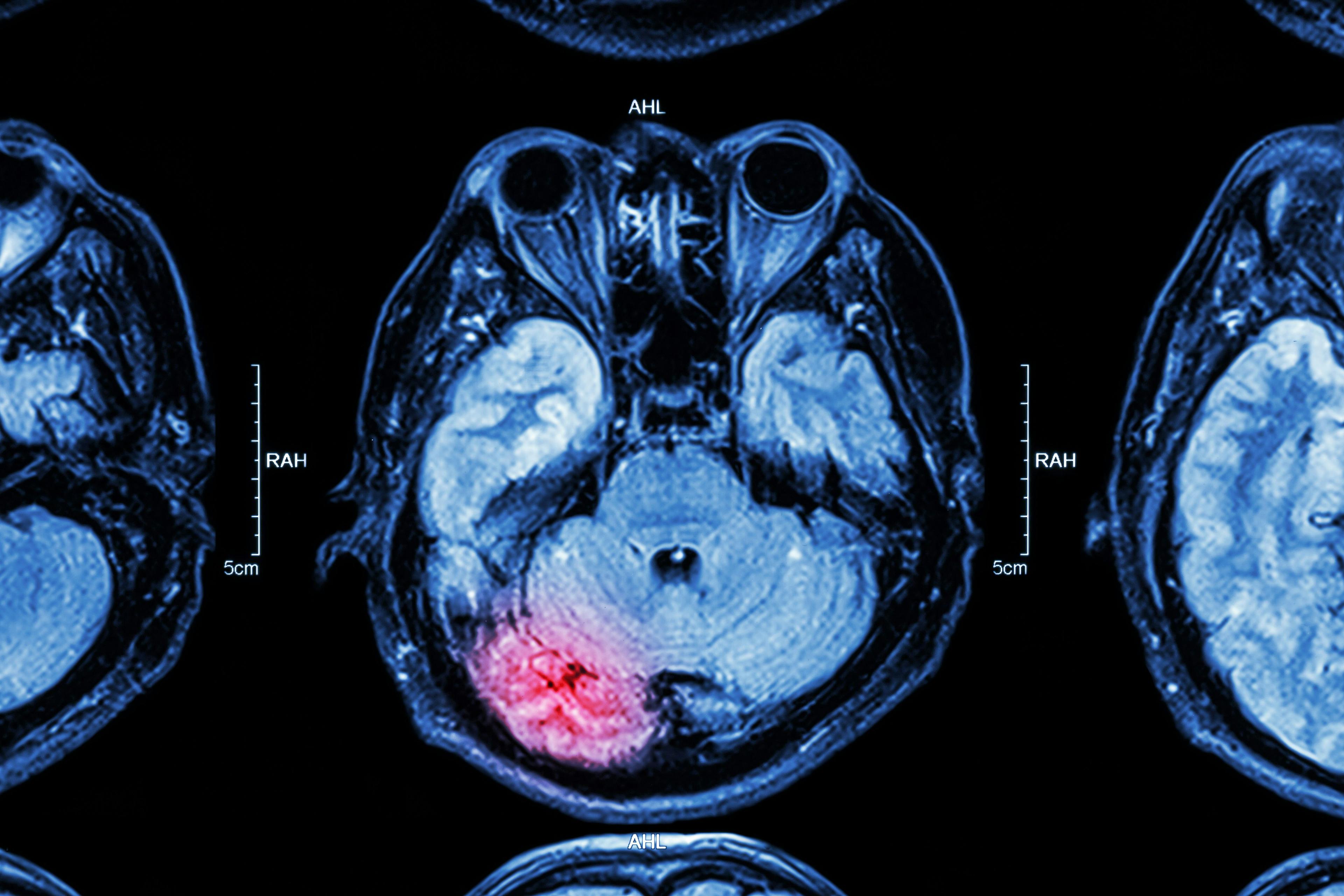 MRI of brain : brain injury | Image Credit: © stockdevil - stock.adobe.com