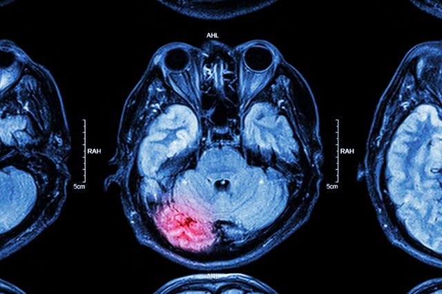 MRI of brain : brain injury | Image Credit: © stockdevil - stock.adobe.com